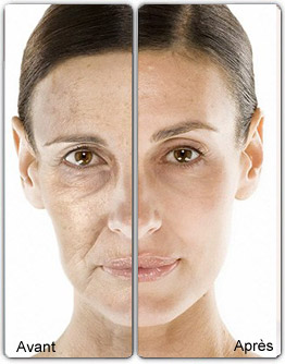 Mésothérapie du visage à Paris - CSHP Mésothérapie du visage à Paris - CSHP