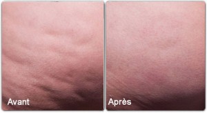 cellulite fesses avant apres cellfina