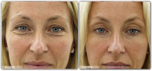 botox rides visage