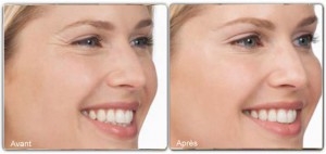 botox-before-and-after