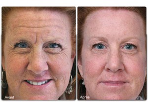 Botox rides visage