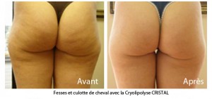 Cellulite des fesses - Avant / Après Cryolipolyse