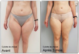 photo cryolipolyse avant après
