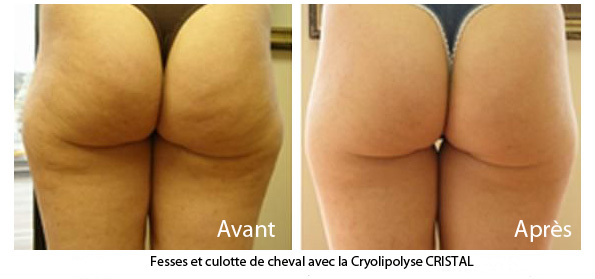 Prix de la Cryolipolyse à Paris - CSHP Prix de la Cryolipolyse à Paris - CSHP