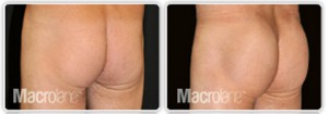 macrolane fesses avant apres