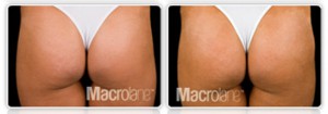fesses galbées macrolane avant apres