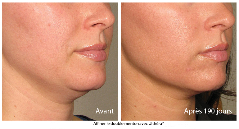cryotherapie double menton cryotherapie double menton