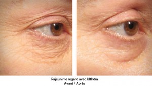 rajeunir-le-visage-san-chirurgie-centre-ultherapy-paris