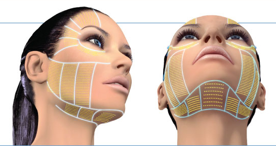 ultherapy