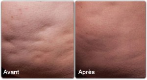 cellfina sur fesses - cellulite avant apres