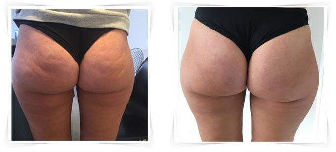 Quel effet des bas de contention sur la cellulite ? - Cellublue