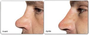 rhinoplastie médicale avant apres