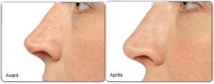 Rhinoplastie médicale - Avant / Apres