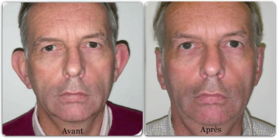 Comment Recoller Les Oreilles Sans Chirurgie Cshp Paris