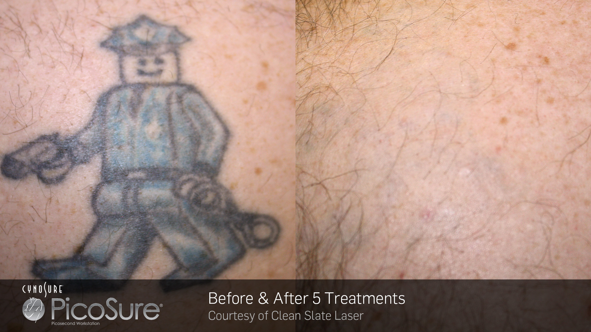 Détatouage laser comment enlever un tatouage ? CSHP Paris