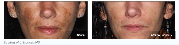 picosure tâches