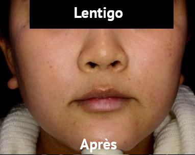 lentigo