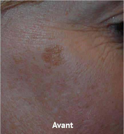 avant1-taches-picosure