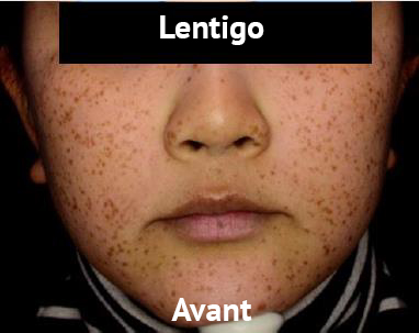avant4-lentigo-picosure