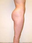Résultat injections fesses profil 3 - Après