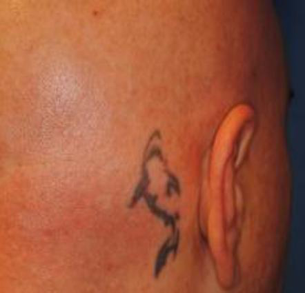 tatoo9-avant picosure