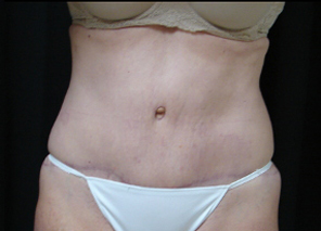 abdominoplastie avant apres