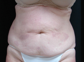 abdominoplastie avant apres