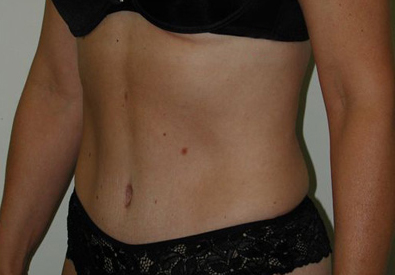 abdominoplastie avant apres