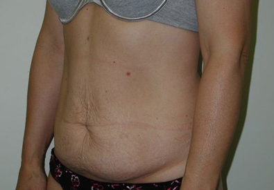 abdominoplastie avant apres