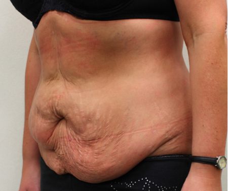 abdominoplastie avant apres