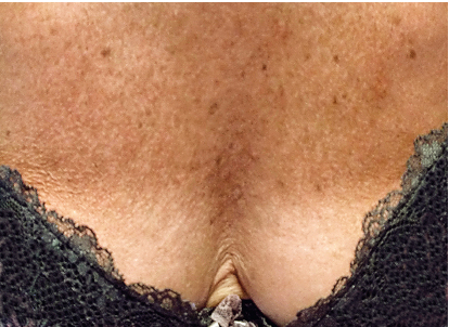 prx-t33 decolleté avant apres