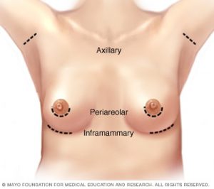 cicatrices augmentation mammaire