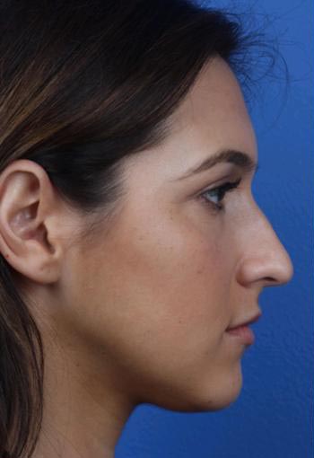 rhinoplastie avant apres