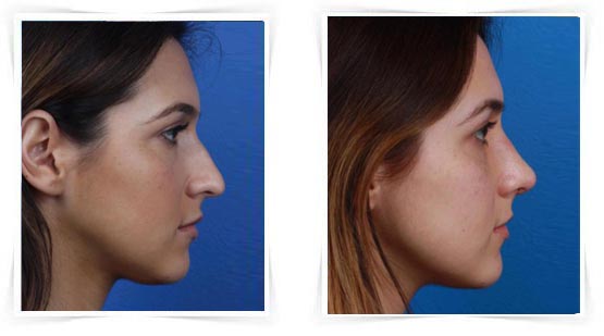 Prix d'une rhinoplastie en france