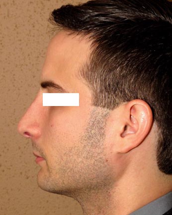 rhinoplastie avant apres