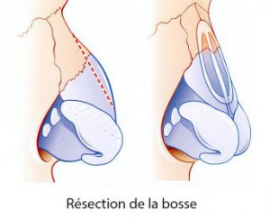 rhinoplastie-schema