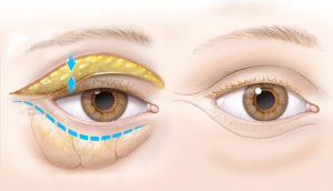 schema blepharoplastie