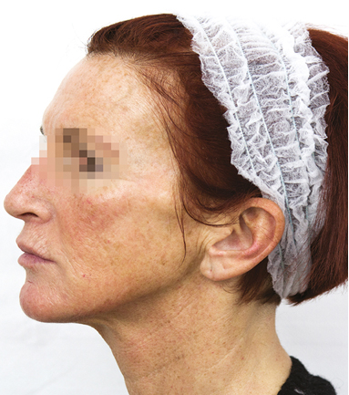 prx-t33 visage avant apres