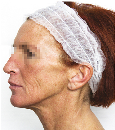 prx-t33 visage avant apres