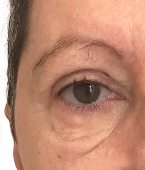 blepharoplastie apres