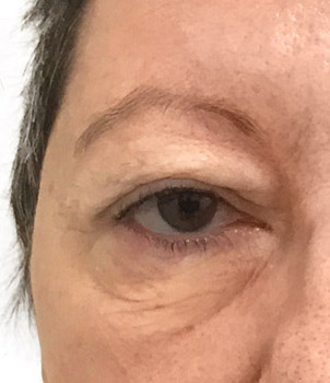 blepharoplastie avant