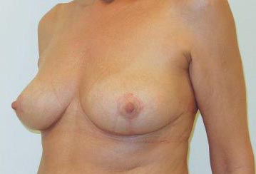 breast reduction avant apres