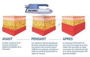 shéma emsculpt