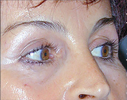 blepharoplastie apres