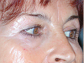 blepharoplastie avant