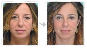 blepharoplastie avant apres