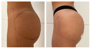 avap hyacorp fesses