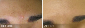 avant apres hydrafacial