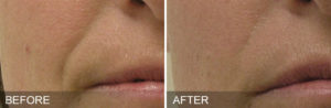 avant apres hydrafacial