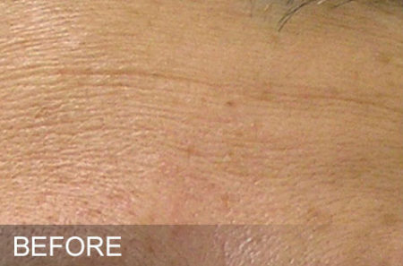 hydrafacial avant apres cshp